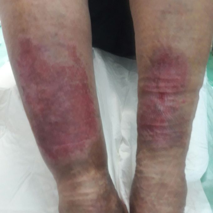 treatment  after