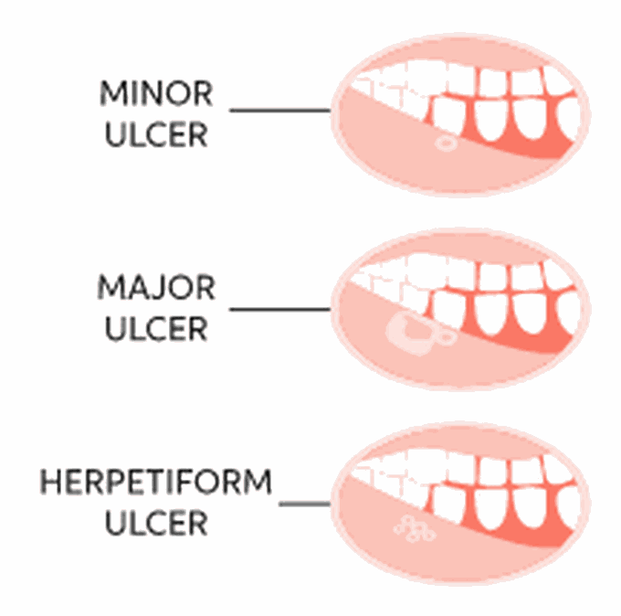 Types of mouth ulcers
