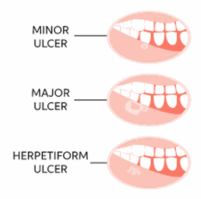 types-of-mouth-ulcers-medizzy