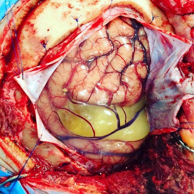 Arachnoid cyst