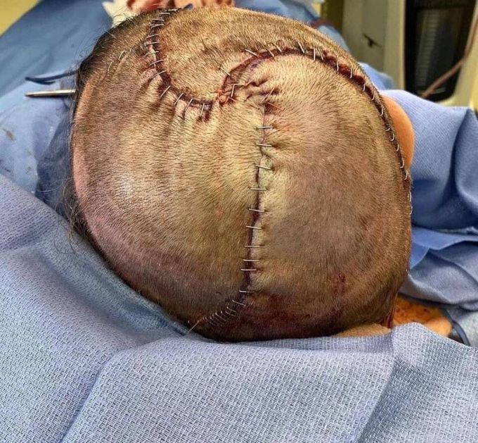 Skin flap reconstruction
