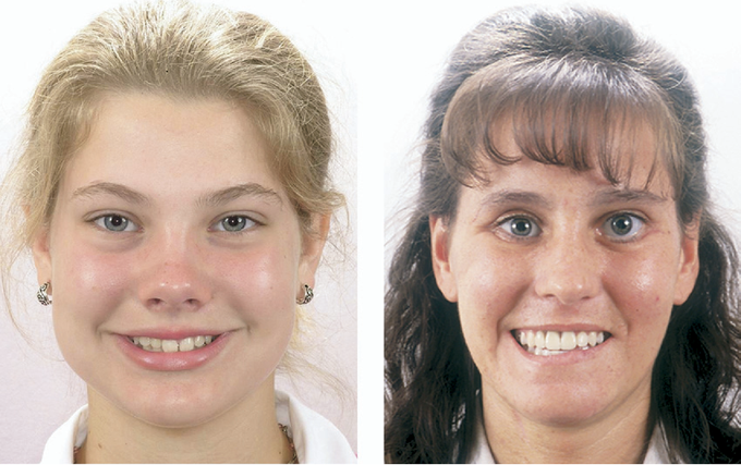 Yaw in orthodontics
