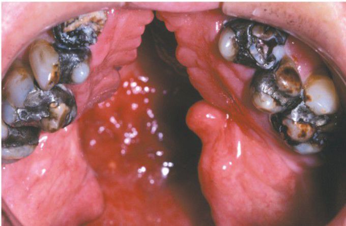 Cleft palate