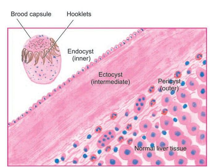 Hydatid cyst