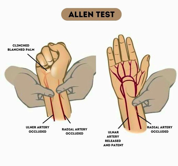 Allen Test