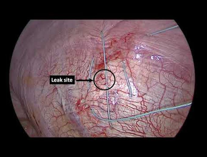 Thoracoscopic Management of Pleural Effusion Resulting From Peritoneal Dialysis (PD Hydrothorax)