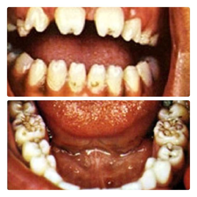Tooth Deformities in Congenital Syphilis