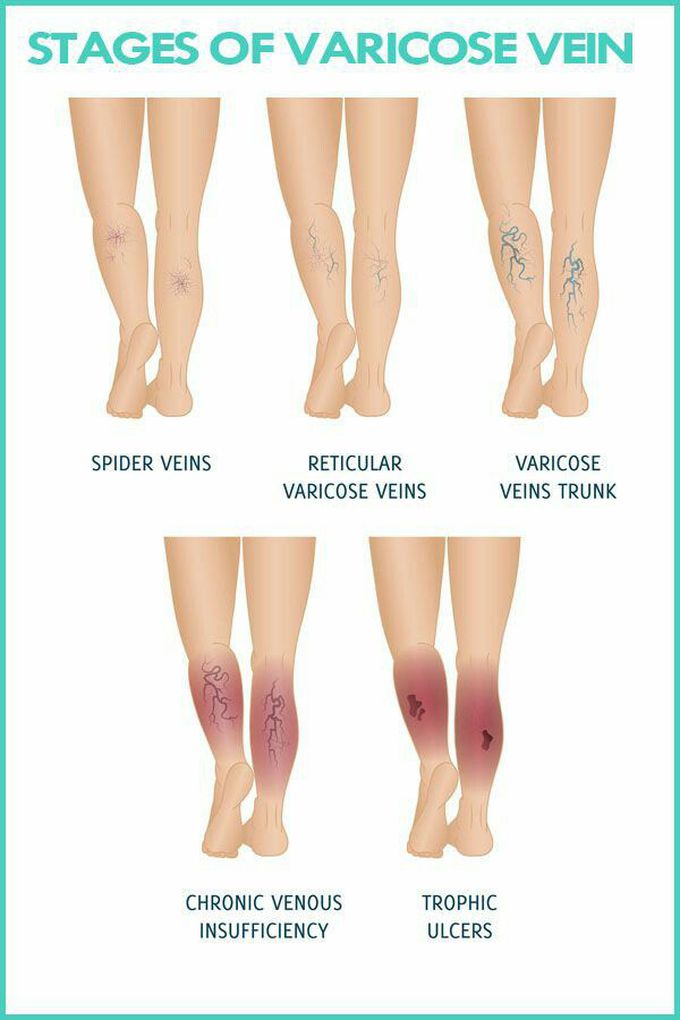 Varicose veins