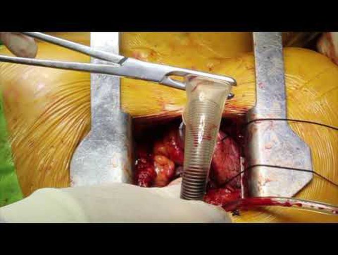 Ministernotomy for Aortic Valve Replacement