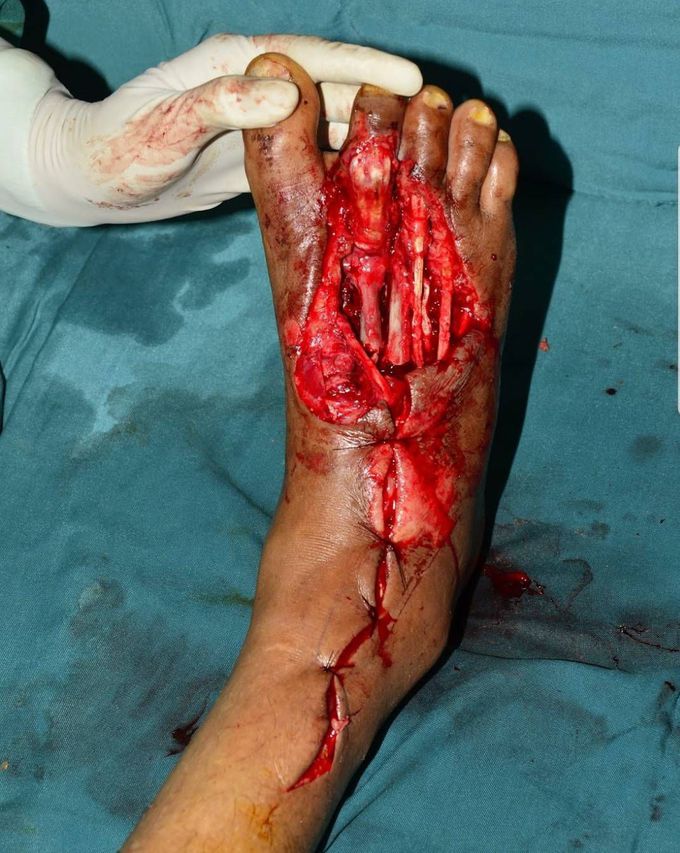 Right foot crush injury