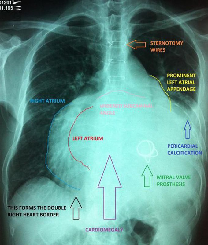 Mitral Stenosis