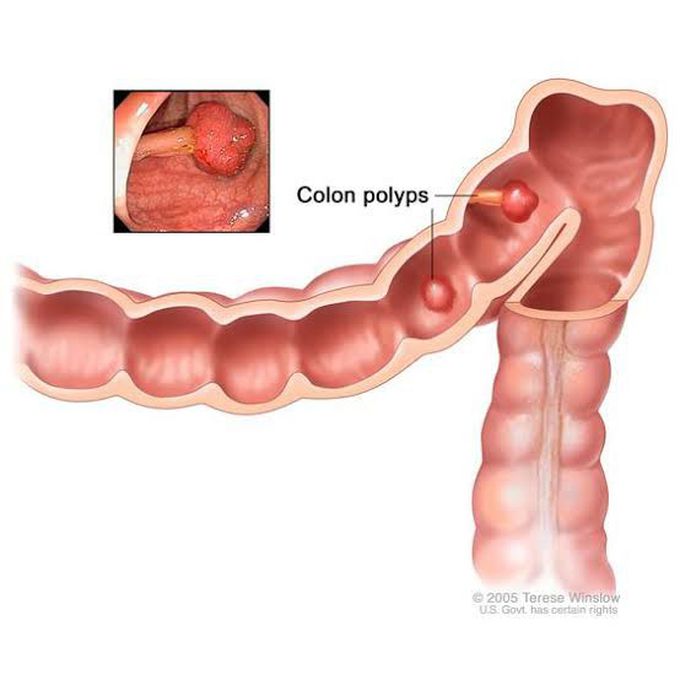 How to treat bowel polyps?