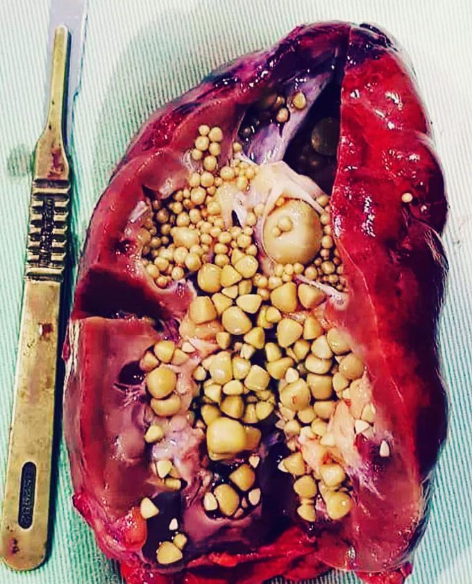 Kidney stones