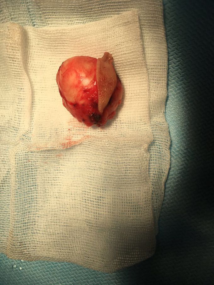 Normal lipoma)