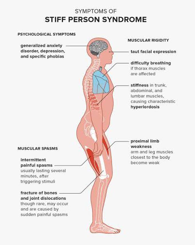 These are the symptoms Stiff person syndrome