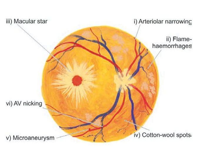 Hypertension