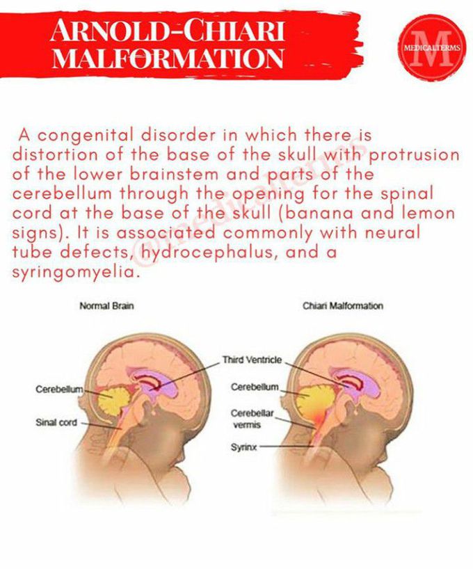 Arnold-chiari malformation