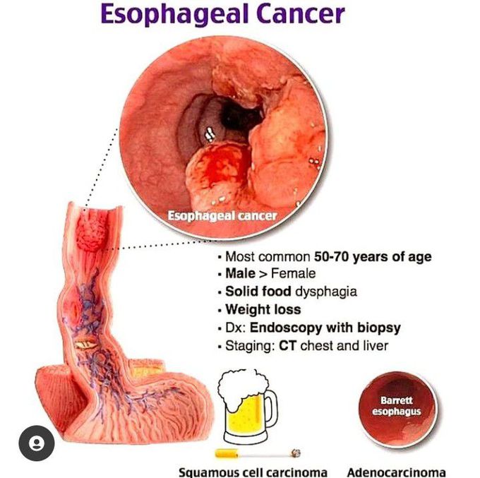 Esophageal cancer