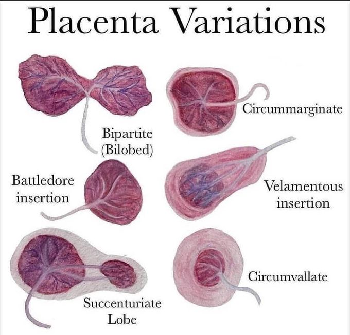 Placental Variation