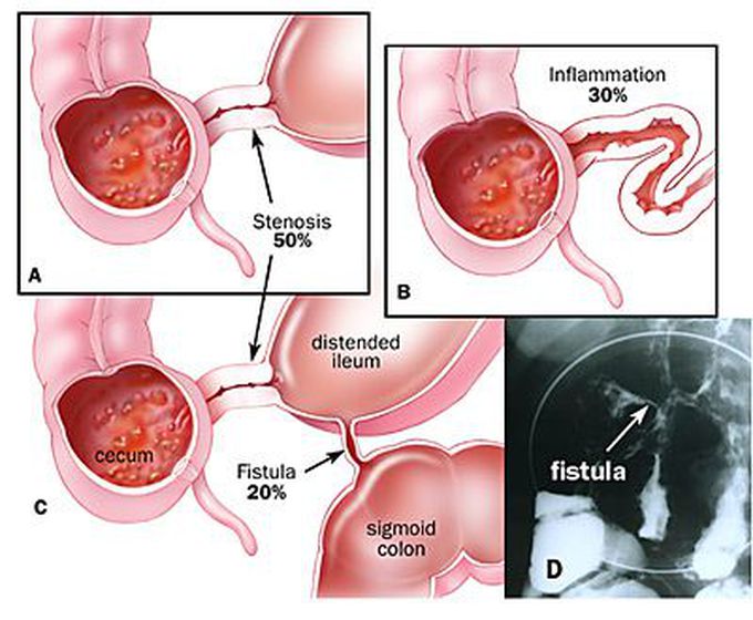 Crohn's Disease Symptoms 