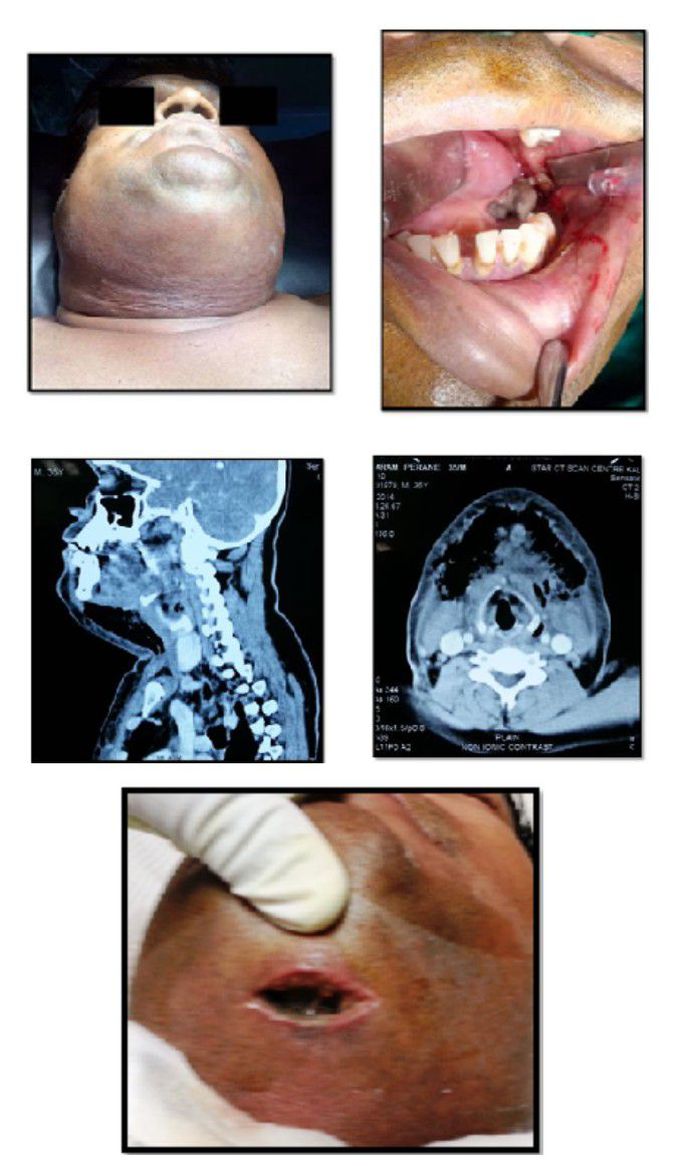Gas Gangrene in the Neck Caused by an Odontogenic Infection