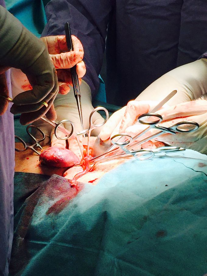 Kidney transplant 🔃