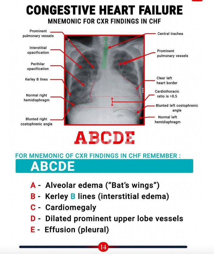 Congestion Heart Failure