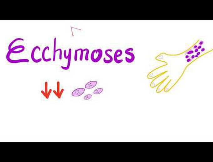 Ecchymoses | Low Platelet Count