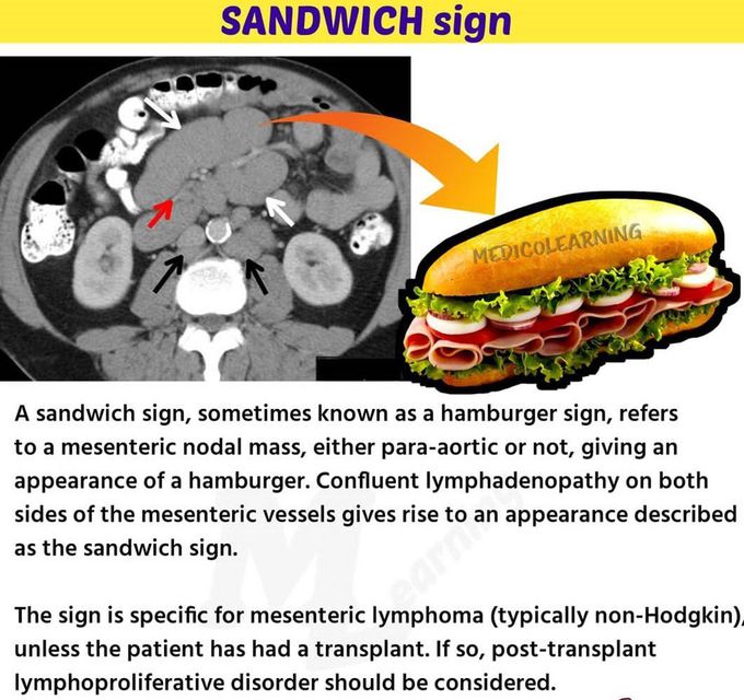 Sandwich sign