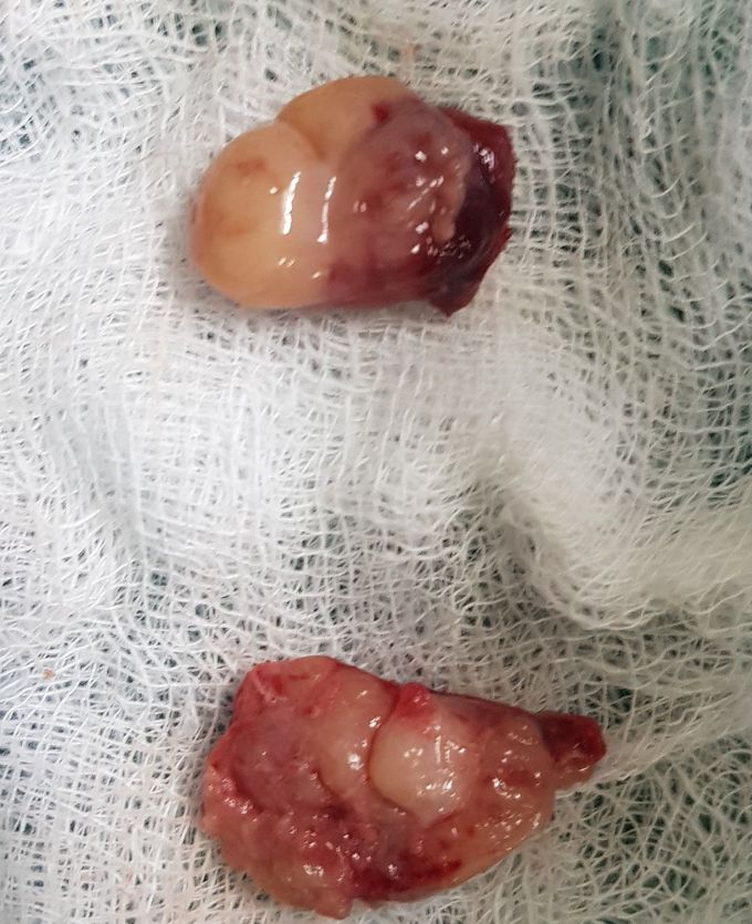 Tonsils.