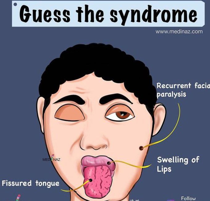 Can you guess the syndrome? Drop down the answers below