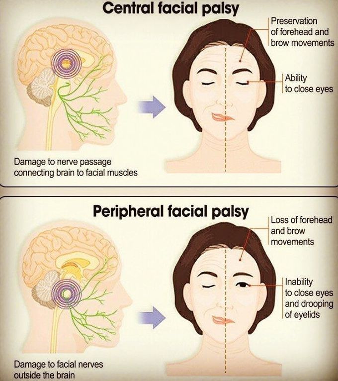 Facial palsy
