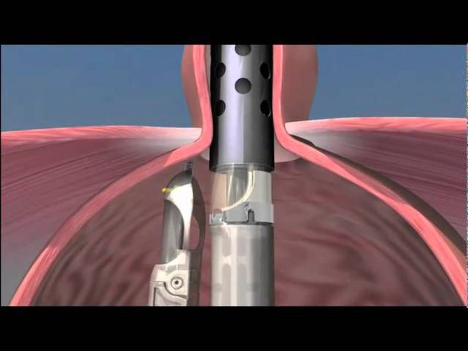 TIF Minimally Invasive Surgery Procedure  for Chronic Heartburn