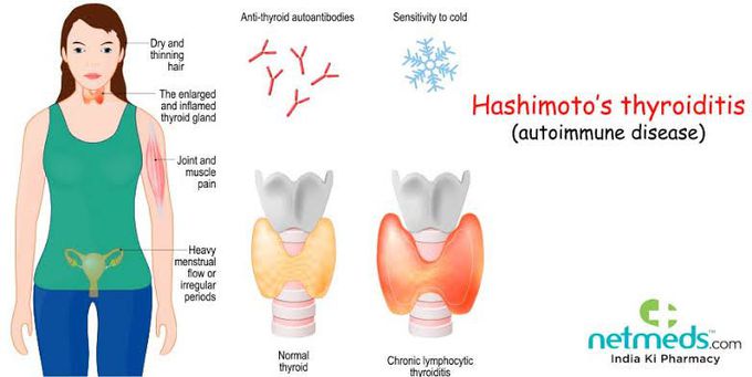 Hashimotos disease