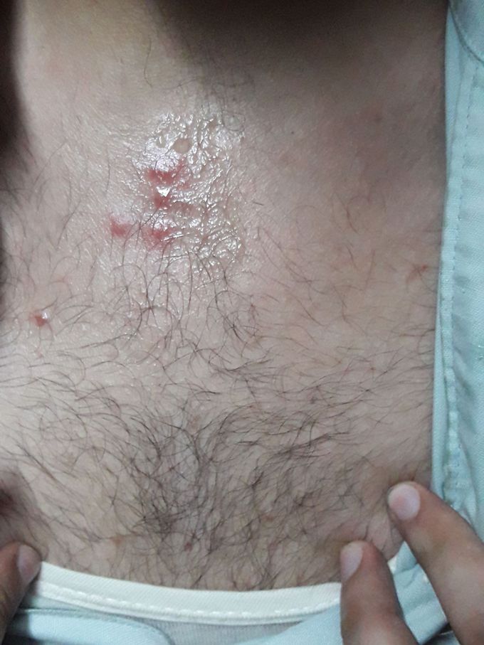 Dx?? Rashes ..
