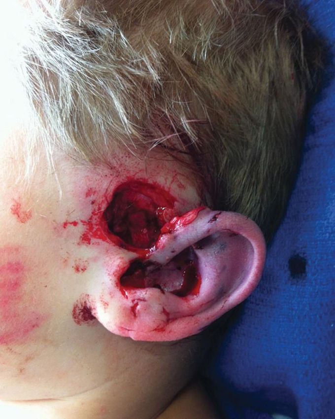 Dog Bite injury