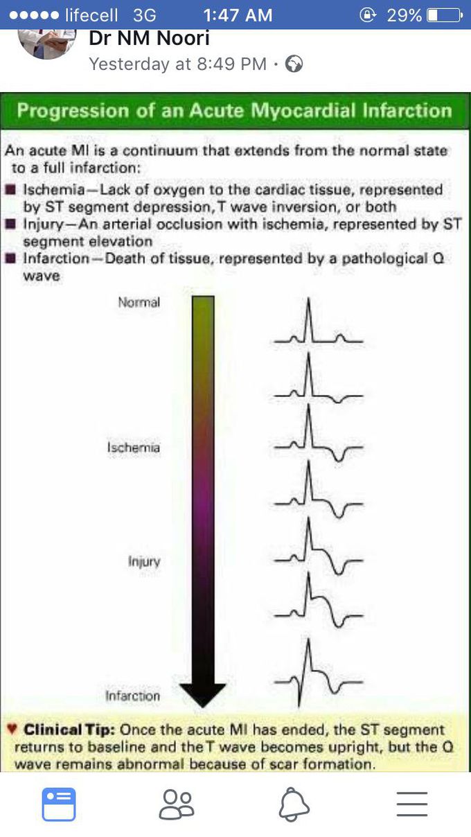 ECG