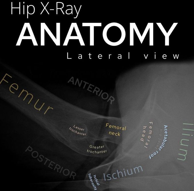 Lateral Hip X-ray Anatomy