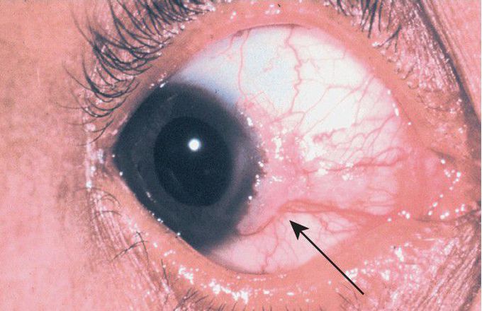 Hereditary Benign Intraepithelial Dyskeratosis (HBID).