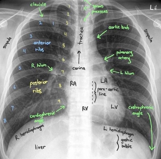 Chest X-ray