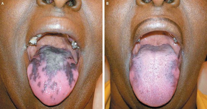 Chemotherapy-Induced Hyperpigmentation of the Tongue