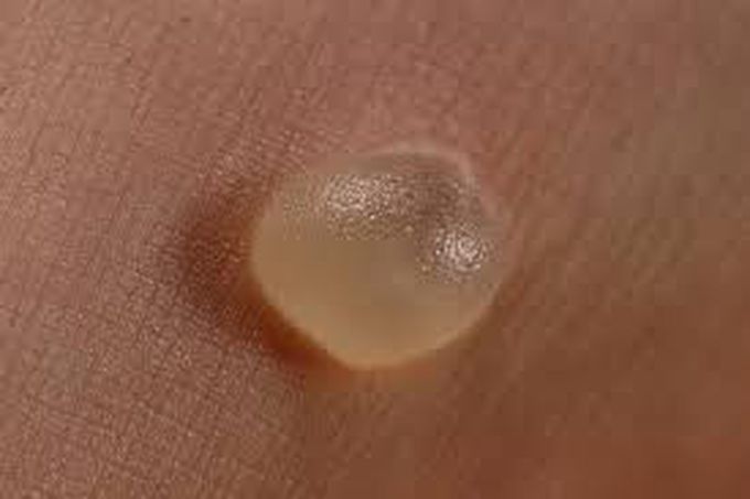 Blisters