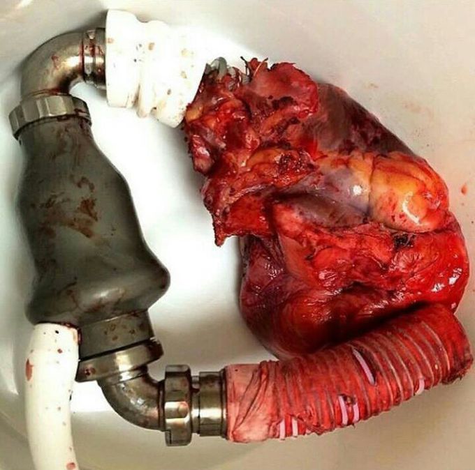 LVAD (Left  Ventrical Assist Device