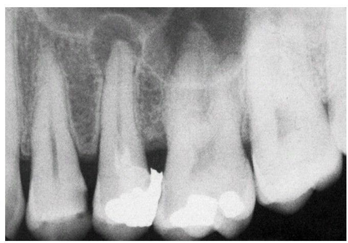 Granuloma of second premolar