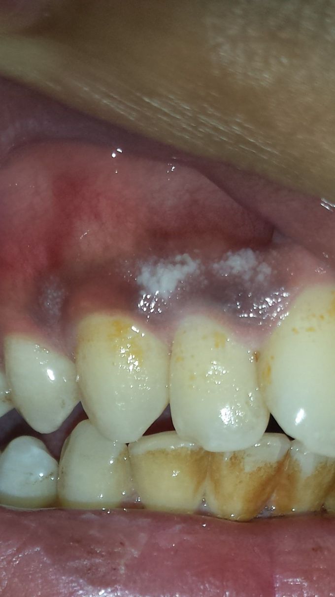 Cause of White gums