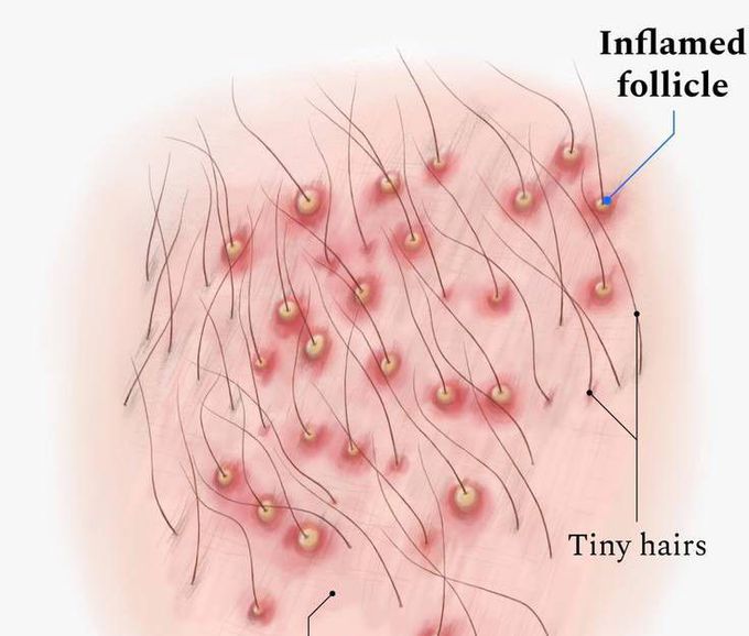 Folliculitis