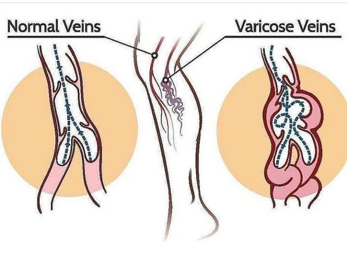 Normal Vs Varicose veins