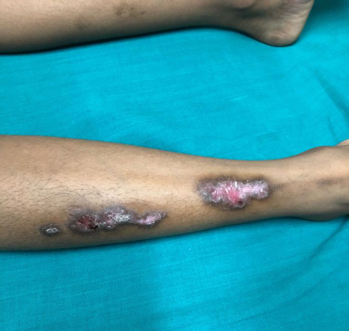 What is the likely diagnosis?