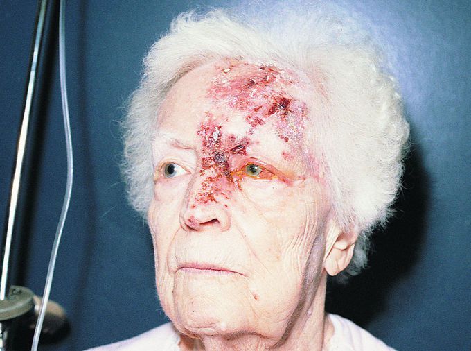 Herpes Zoster Ophthalmicus
