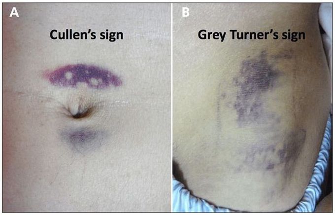 Cullen's Vs Grey Turner's Sign